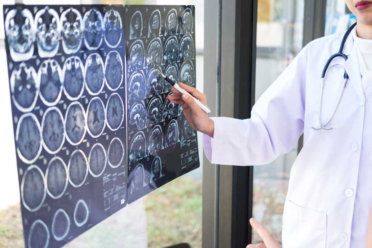 How to Spot the Early Warning Signs of Stroke Risk
